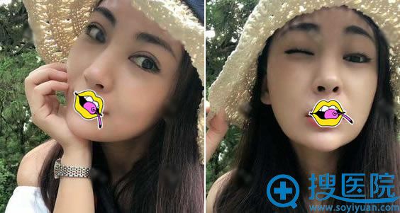 做完双眼皮手术10天后恢复效果 做完双眼皮手术10天后恢复效果