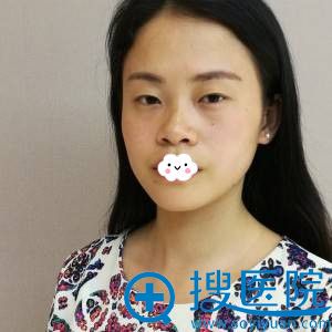 想上抖音颜值不够怎么揽粉?成都铜雀台江涛肋软骨隆鼻真人案例