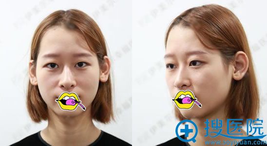 北京伊美尔和叶子医院双眼皮案例PK后选择郭海燕做全切双眼皮