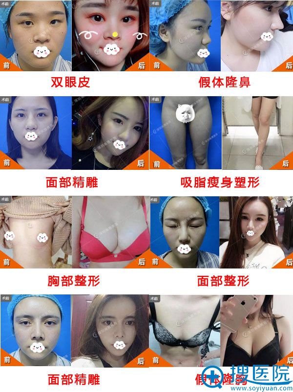 深圳南雅医疗美容整形真人案例 深圳南雅医疗美容整形真人案例