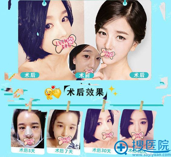 <!--<i data=20240710 data-id=13118></i>-->王文革院长鼻综合整形案例及恢复过程图 <!--<i data=20240710 data-id=13118></i>-->王文革院长鼻综合整形案例及恢复过程图