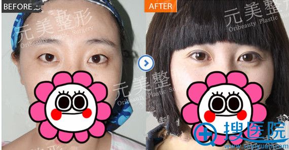 <!--<i data=20240710 data-id=13118></i>-->整形王文革双眼皮整形案例前后对比图 <!--<i data=20240710 data-id=13118></i>-->整形王文革双眼皮整形案例前后对比图