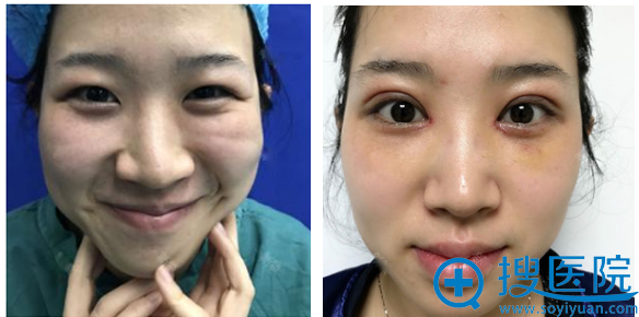 现在看来找上海百达丽整形医院李茂群医生做双眼皮真是明智选择