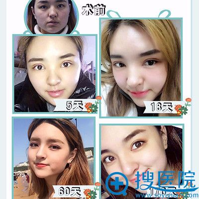上海江依南整形医院<!--<i data=20240710 data-id=16017></i>-->双眼皮眼综合案例 上海江依南整形医院<!--<i data=20240710 data-id=16017></i>-->双眼皮眼综合案例