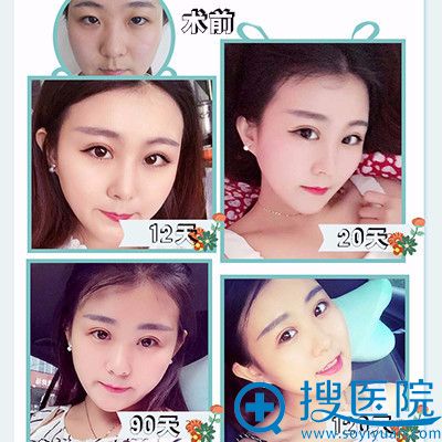 上海江依南整形医院<!--<i data=20240710 data-id=16017></i>-->切开双眼皮案例图 上海江依南整形医院<!--<i data=20240710 data-id=16017></i>-->切开双眼皮案例图