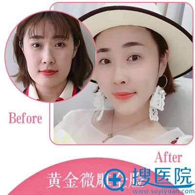 上海江依南整形医院<!--<i data=20240710 data-id=16017></i>-->射频溶脂瘦脸案例 上海江依南整形医院<!--<i data=20240710 data-id=16017></i>-->射频溶脂瘦脸案例