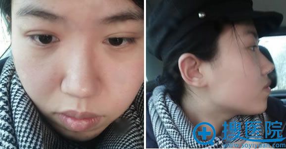 做鼻综合隆鼻手术前照片 做鼻综合隆鼻手术前照片