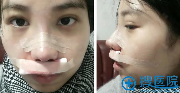 安国华隆鼻案例即刻效果图 安国华隆鼻案例即刻效果图