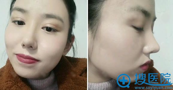 做鼻综合隆鼻手术30天效果 做鼻综合隆鼻手术30天效果