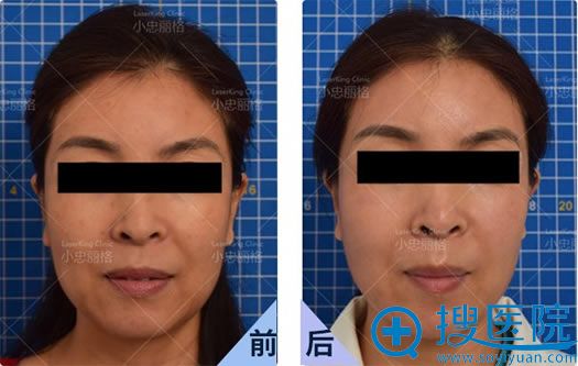 北京小忠丽格皮肤激光美肤案例 北京小忠丽格皮肤激光美肤案例