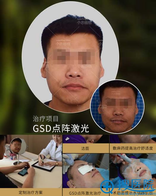小忠丽格激光美肤案例效果图 小忠丽格激光美肤案例效果图