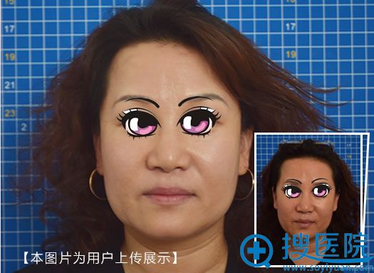 北京小忠丽格面部线雕抗衰案例 北京小忠丽格面部线雕抗衰案例