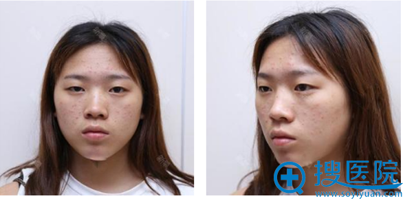 找上海时光整形医院郑志玉做的双眼皮太好看了还想再去做个鼻子