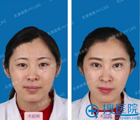 天津美莱毕小丽双眼皮前后对比图 天津美莱毕小丽双眼皮前后对比图