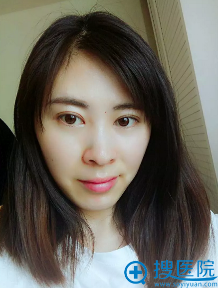 去天津美莱做完双眼皮半个月了 去天津美莱做完双眼皮半个月了