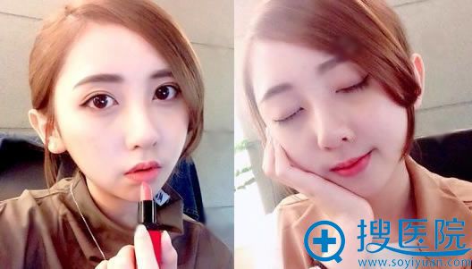 做完双眼皮手术后60天恢复照 做完双眼皮手术后60天恢复照