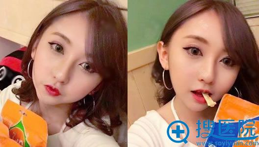 在常州美贝尔做双眼皮4个月后 在常州美贝尔做双眼皮4个月后