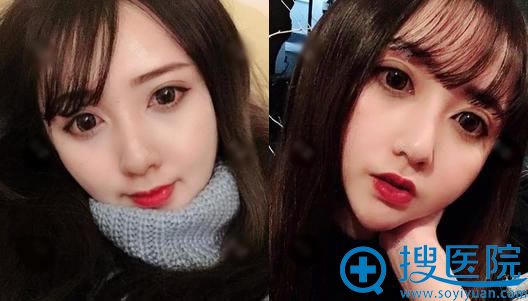 常州美贝尔刘亚军双眼皮案例1年效果 常州美贝尔刘亚军双眼皮案例1年效果
