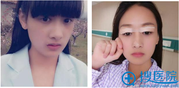 通过对比上海美莱和华美整形医院的案例选择佀同帅做了双眼皮