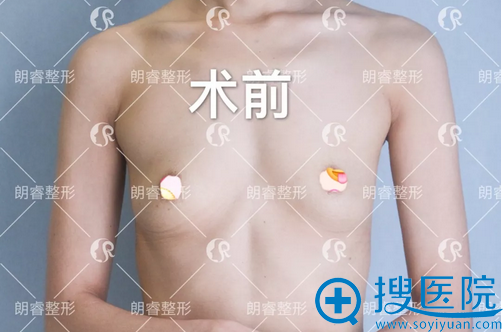 在好友的鼓励下去四川广元朗睿整形医院找卢刚做了自体脂肪隆胸