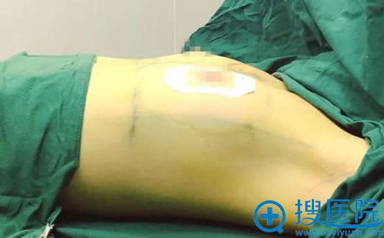 爱臭美的我于6月29日去广州名韩整形医院让彭丽霞做了假体隆胸
