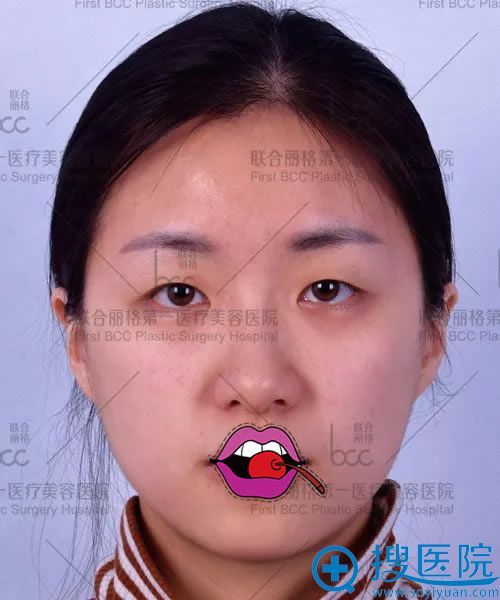 找联合丽格吴焱秋院长做开眼角和双眼皮后摆脱眼皮贴的感觉真好