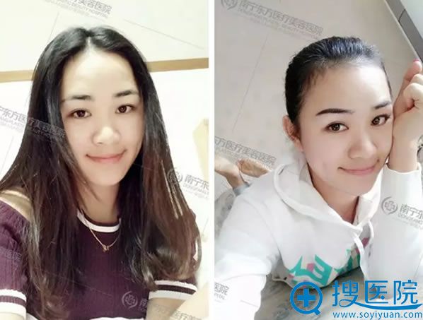 三生有幸南宁东方龙海波和刘刚两位院长昨天帮我做了隆鼻手术