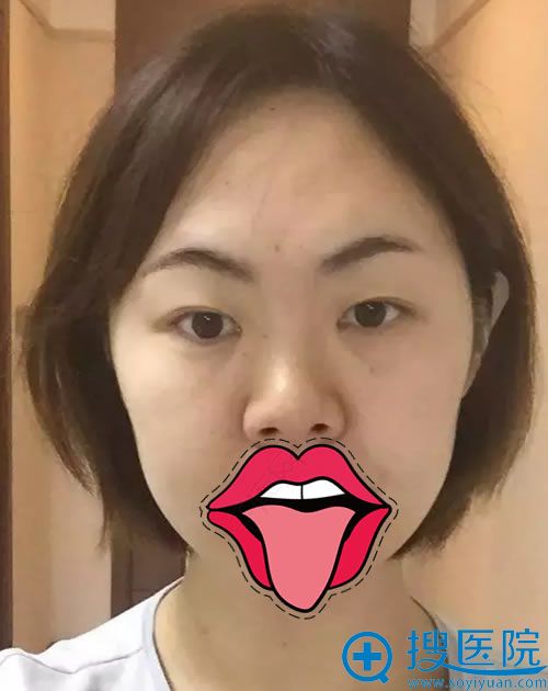 西安伊美尔王飞主任用隆鼻和双眼皮手术终结了我20年塌鼻生活