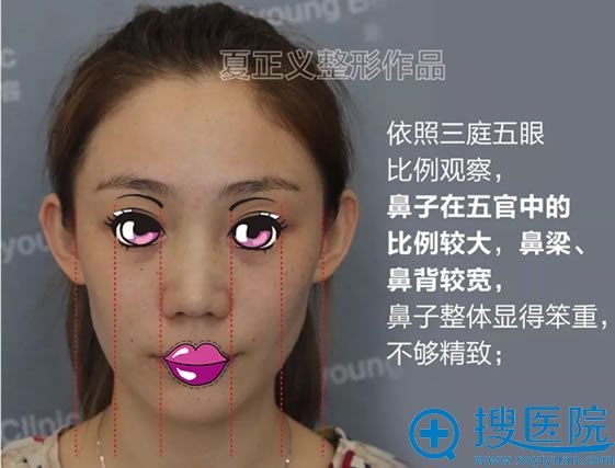 鼻子打了玻尿酸变宽怎么办?米扬丽格夏正义宽鼻缩窄修复案例图