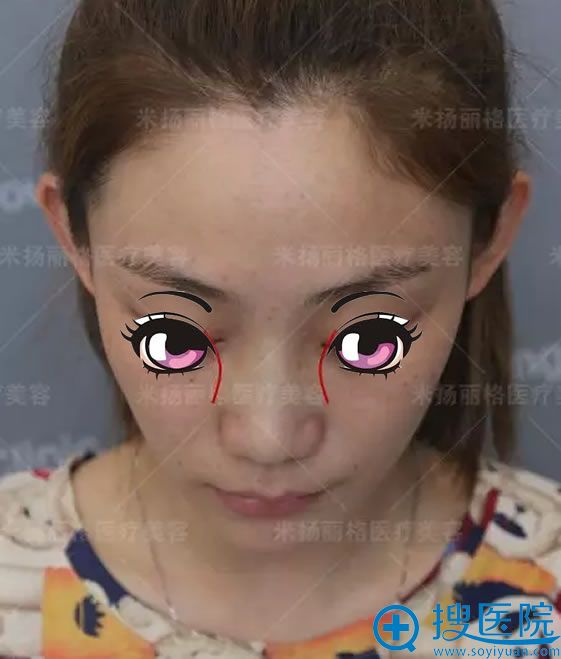 注射玻尿酸溶解酶后的照片 注射玻尿酸溶解酶后的照片