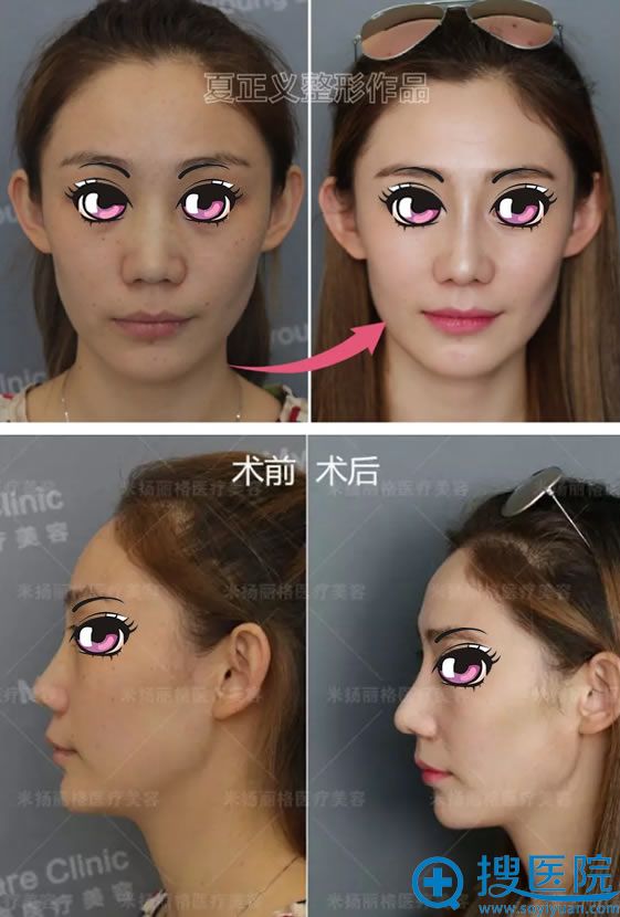 玻尿酸隆鼻失败修复手术1个月后 玻尿酸隆鼻失败修复手术1个月后