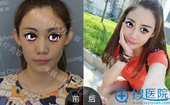 米扬丽格夏正义鼻修复案例对比图 米扬丽格夏正义鼻修复案例对比图