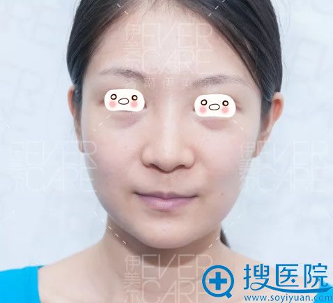 在济南伊美尔整形做自体脂肪填充全脸一个月啦 素颜也美丽