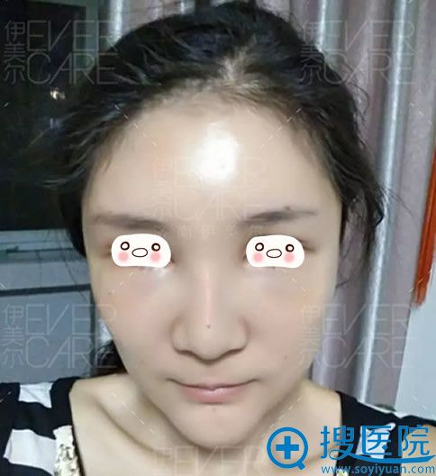 伊美尔整形自体脂肪填充面部术后第1天样子 伊美尔整形自体脂肪填充面部术后第1天样子
