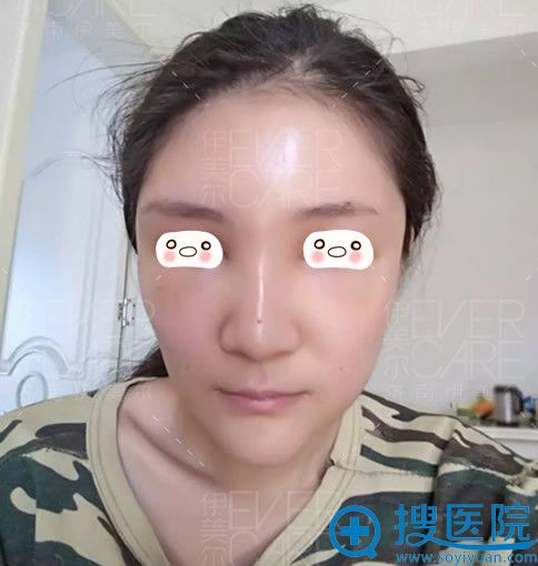 在<!--<i data=20240710 data-id=12670></i>-->整形面部填充自体脂肪术后第5天恢复效果 在<!--<i data=20240710 data-id=12670></i>-->整形面部填充自体脂肪术后第5天恢复效果