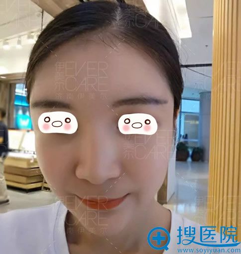 去<!--<i data=20240710 data-id=12670></i>-->整形做面部自体脂肪填充术后第15天照片 去<!--<i data=20240710 data-id=12670></i>-->整形做面部自体脂肪填充术后第15天照片