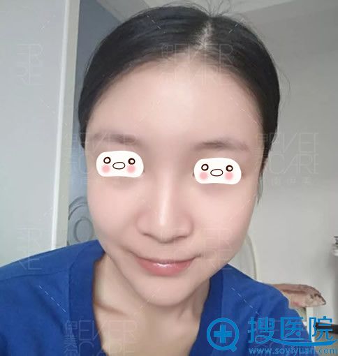 <!--<i data=20240710 data-id=12670></i>-->整形医院面部自体脂肪填充术后第25天效果图 <!--<i data=20240710 data-id=12670></i>-->整形医院面部自体脂肪填充术后第25天效果图