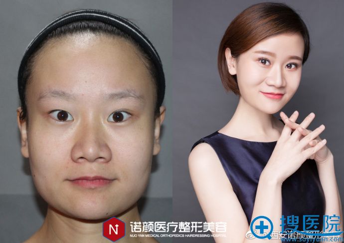 哪种瘦脸方法好?西安诺颜青羽光雕瘦脸:瘦脸不反弹