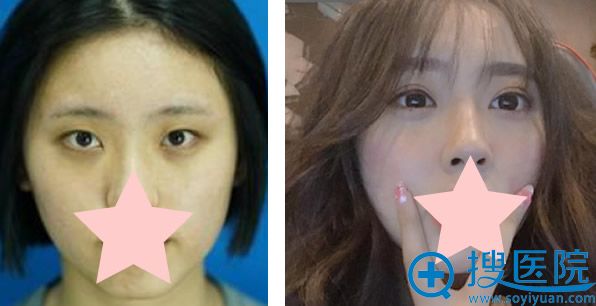 无锡施尔美全切双眼皮三个月恢复效果案例 无锡施尔美全切双眼皮三个月恢复效果案例