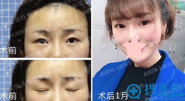 无锡爱思特双眼皮整形失败修复效果案例 无锡爱思特双眼皮整形失败修复效果案例