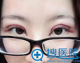 刚做完眼综合整形的照片 刚做完眼综合整形的照片