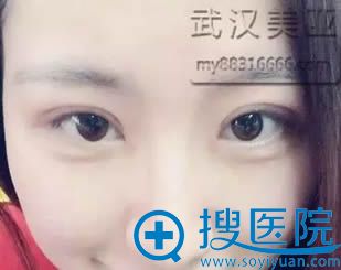 在<!--<i data=20240710 data-id=12634></i>-->让刘佳亮做完双眼皮和开眼角术后30天照片 在<!--<i data=20240710 data-id=12634></i>-->让刘佳亮做完双眼皮和开眼角术后30天照片