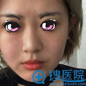 从鲁礼新做鼻综合5个月效果来看北京叶子医院做鼻子修复怎么样
