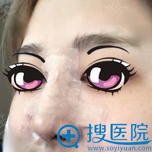 找叶子鲁礼新做完鼻子5天效果 找叶子鲁礼新做完鼻子5天效果