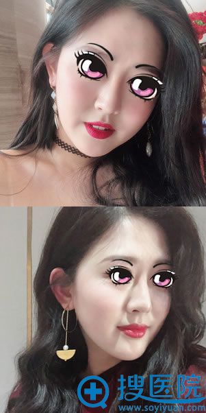 做完隆鼻术后120天的样子 做完隆鼻术后120天的样子