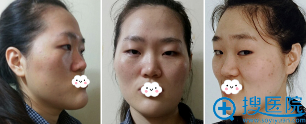 <!--<i data=20240710 data-id=12062></i>-->双眼皮+下巴整形真人案例 <!--<i data=20240710 data-id=12062></i>-->双眼皮+下巴整形真人案例