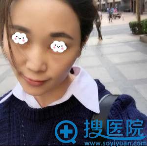 自从我在深圳广尔美丽王天国处做假体隆鼻后都说我美的高冷