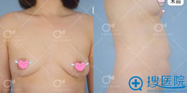 快看我在北京亚馨美莱坞美容院找王文娟医生做自体脂肪隆胸效果