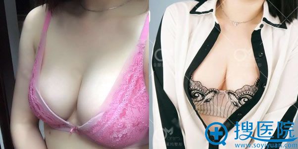 做完自体脂肪隆胸20天恢复照 做完自体脂肪隆胸20天恢复照