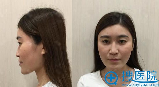 塌鼻子的我选择找北京叶美人程志伟做膨体+耳软骨隆鼻来改变